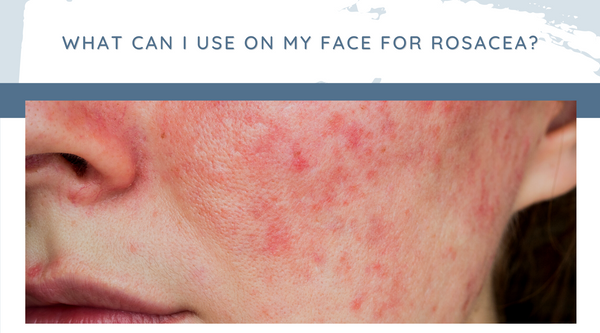 What can I use on my face for rosacea?