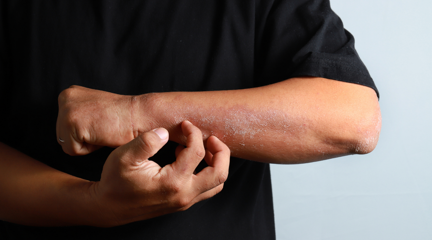 Eight must-have products for eczema sufferers