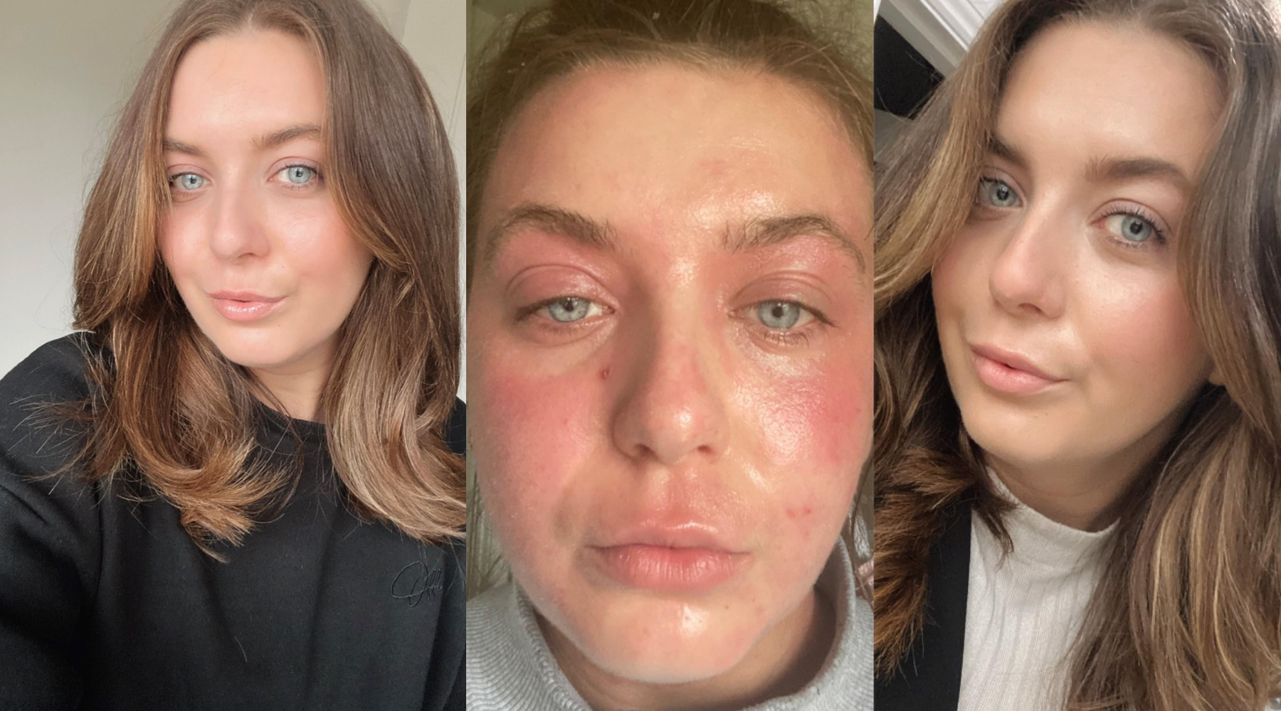 Summer skin positivity with Emily Bowen