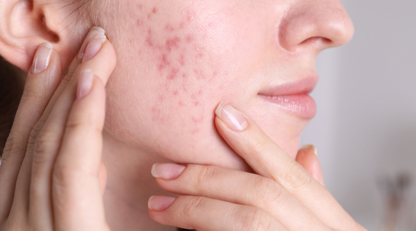 Tips for Hormonal Acne