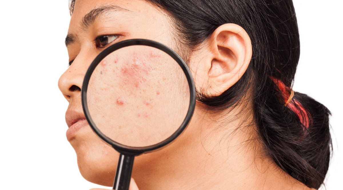 What is acne?