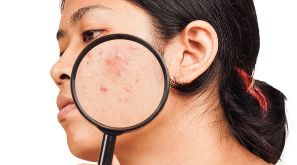 Acne Awareness Month, What is acne?